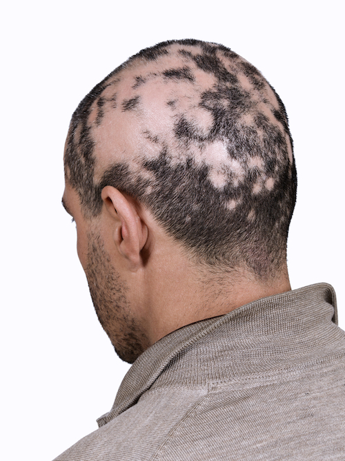 What Is Alopecia Areata Alopecia Areata Hair Loss Treatment Srs