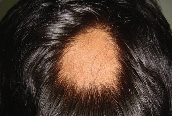 Types Of Alopecia Areata Alopecia Areata Hair Loss Treatment Srs